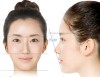 Phẫu thuật độn cằm giúp chỉnh hình dáng cằm để tạo vẻ đẹp hài hòa cho khuôn mặt